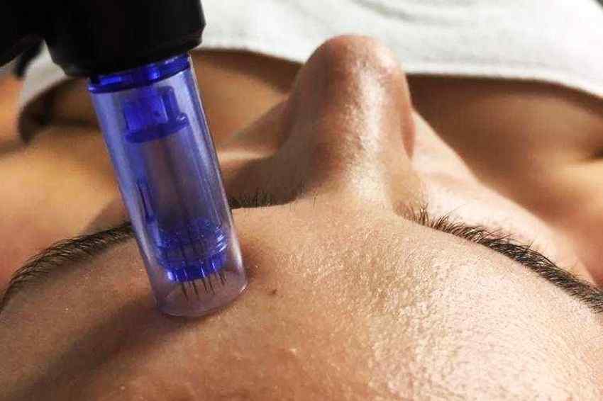 Dermaroler i dermapen