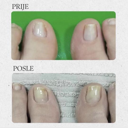 Sneža #podgorica Medicinski pedikir LIFT UP GEL (1 nokat)