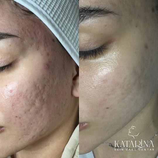 Katarina skin care centar #podgorica Tretman lica Hemijski piling lica + dermapen
