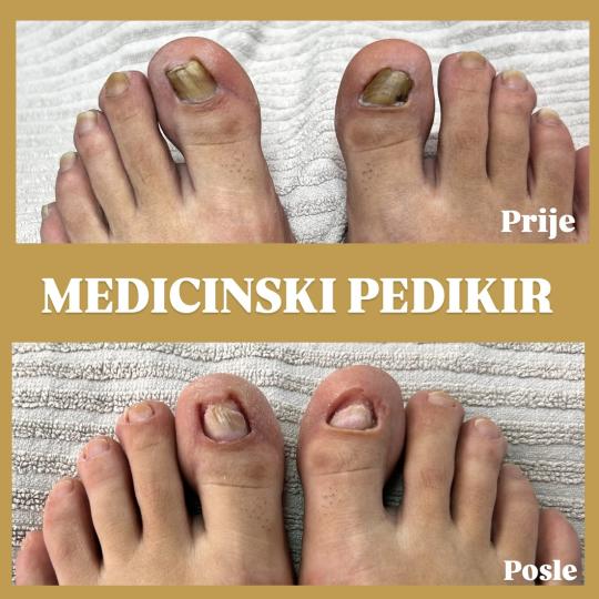 Sneža #podgorica Medicinski pedikir Medicinski pedikir(rešavanje svih problema)