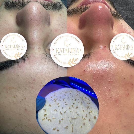 Katarina skin care centar #podgorica Tretman lica Higijenski tretman lica