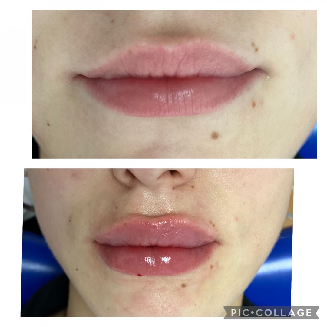 Hijaluronski fileri - 1 ml - Ordinacija Zečević, Podgorica Hijaluronski tretmani lica Lice Hijaluronski tretmani lica, Podgorica, Centar