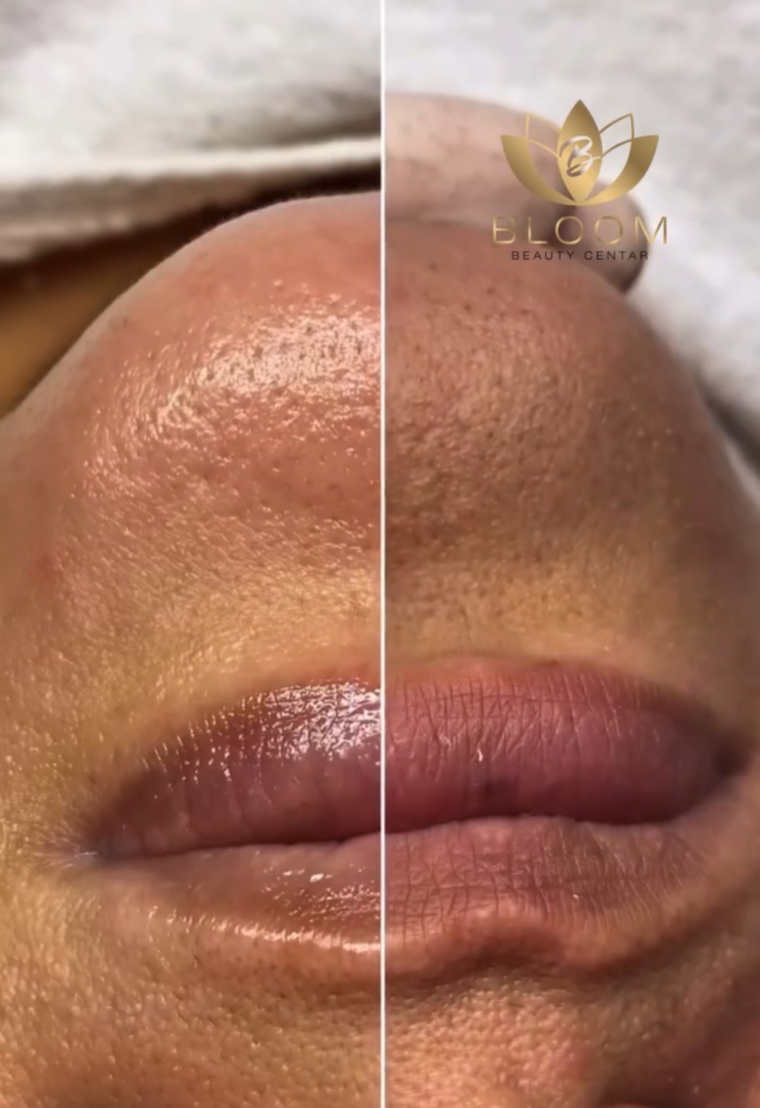 Bloom Beauty Centar #podgorica Tretman lica Higijenski tretman lica - Byotea