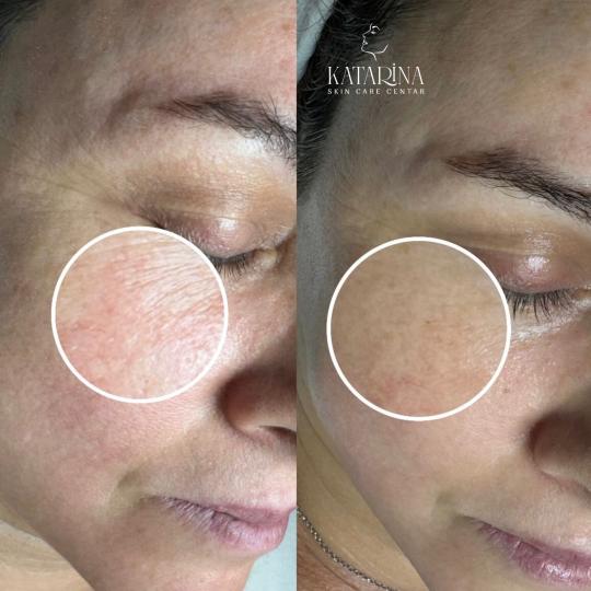 Katarina skin care centar #podgorica Tretman lica Mezoglow - hemijski piling + dermapen + mezoterapi