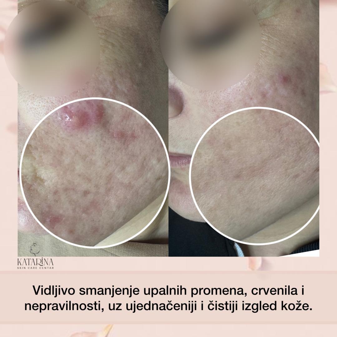 Green Sea peel Krx - Katarina skin care centar, Podgorica Tretman lica Lice Tretman lica, Podgorica, Centar