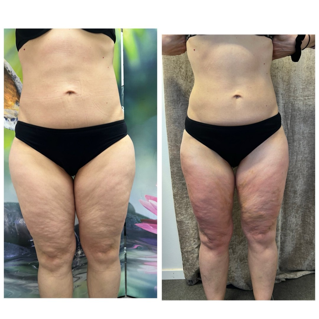 Modni studio Maja #podgorica Tretmani tijela Velashape tretman - noge + gluteus