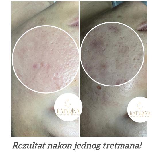 Katarina skin care centar #podgorica Tretman lica Hemijski piling lica + dermapen