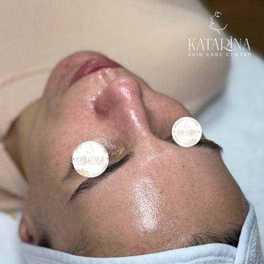 Katarina skin care centar #podgorica Tretman lica Hydrafacial RETINOL glow