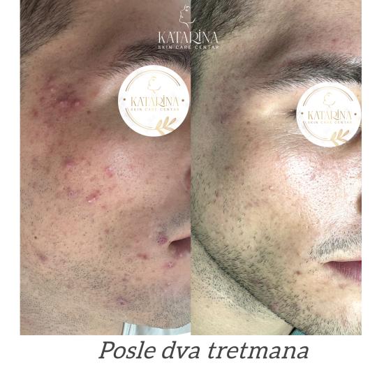 Katarina skin care centar #podgorica Tretman lica Hemijski piling lica + dermapen