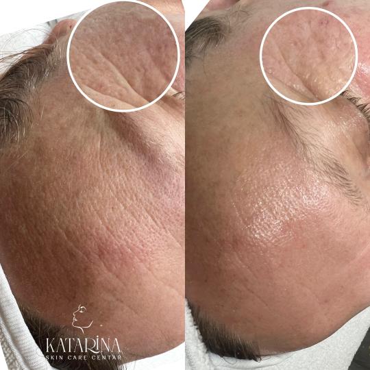 Katarina skin care centar #podgorica Tretman lica Hydrafacial RETINOL glow