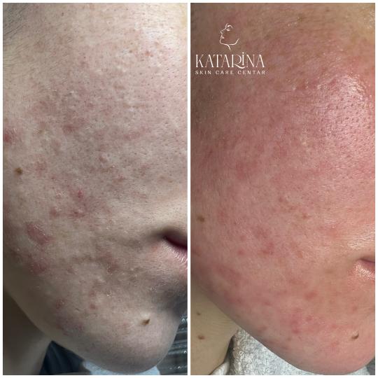 Katarina skin care centar #podgorica Tretman lica Higijenski tretman + hemijski piling