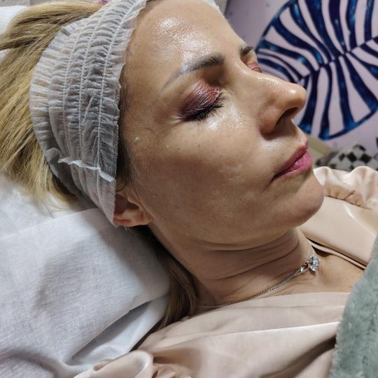 Face glow and nails #podgorica Tretman lica Mix tretmana Tretman lica kolagen nitima + plis kolagen 