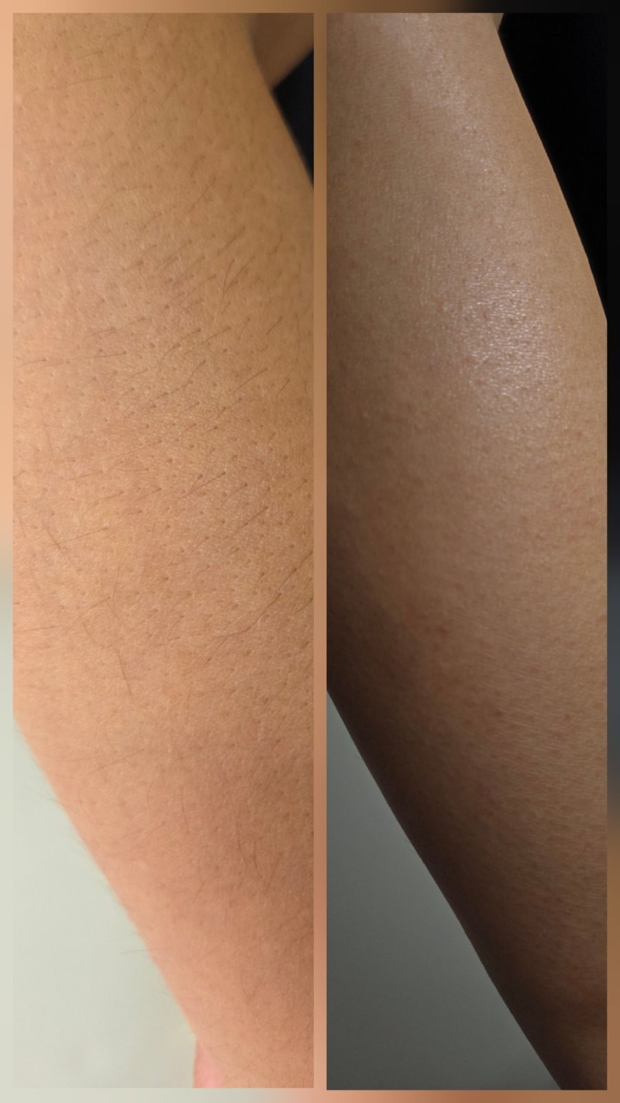 ID Hair #tivat Depilacija šećernom pastom Depilacija cijelih ruku šećernom pastom - za dame