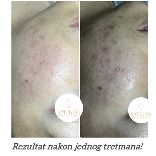 Katarina skin care centar #podgorica Tretman lica Hemijski piling lica + dermapen