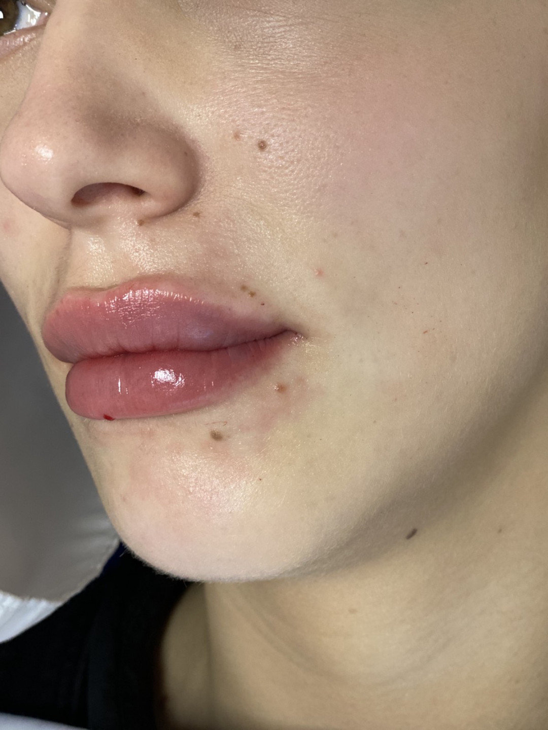 Hijaluronski fileri - 1 ml - Ordinacija Zečević, Podgorica Hijaluronski tretmani lica Lice Hijaluronski tretmani lica, Podgorica, Centar