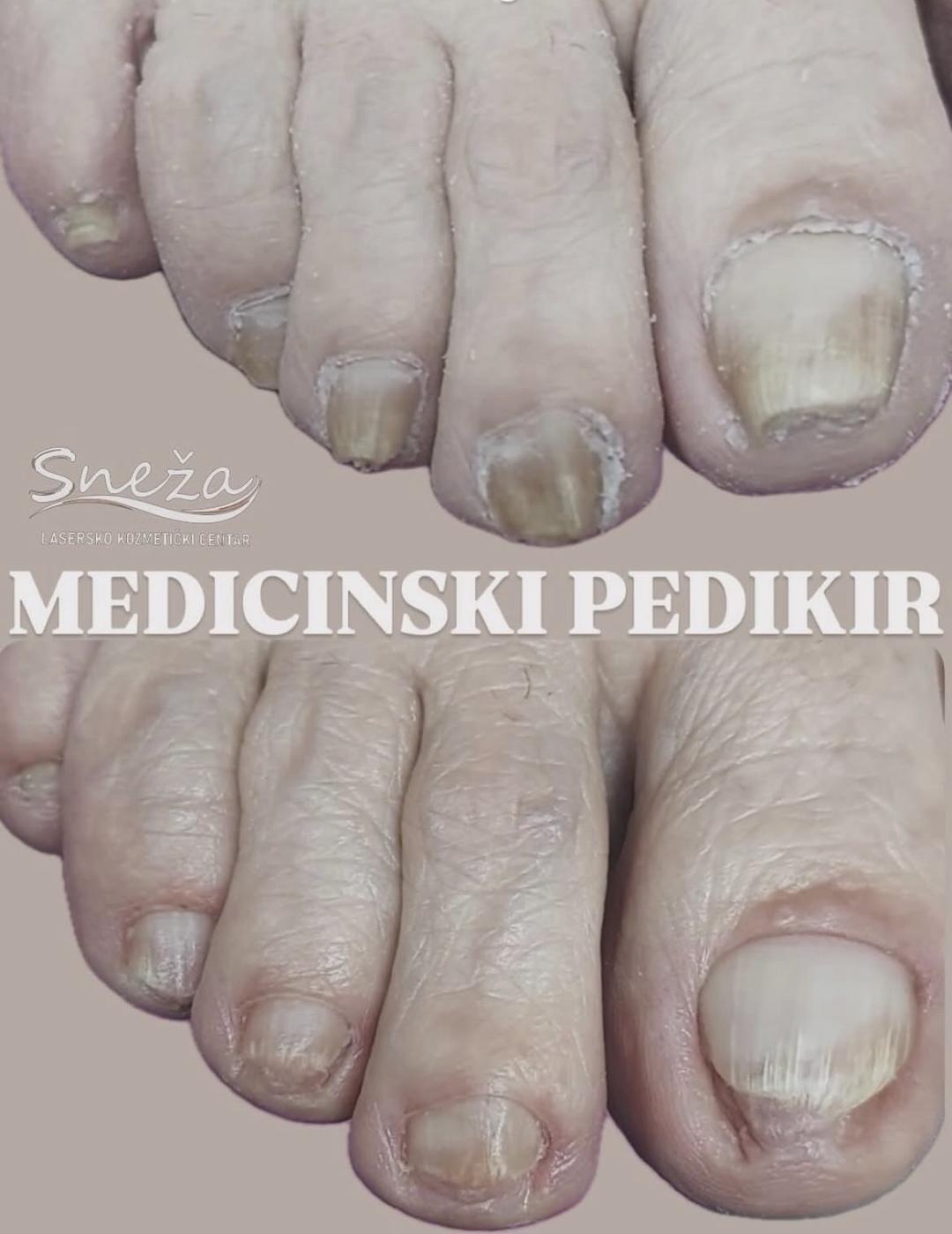 Sneža #podgorica Laserska epilacija Medicinski aparaturni pedikir u poodmakloj fazi