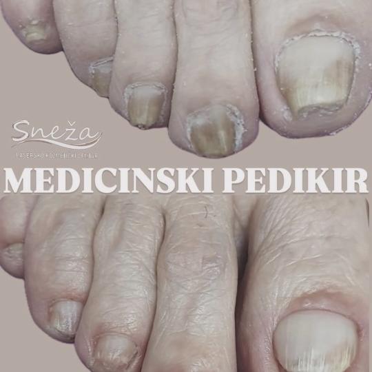 Sneža #podgorica Laserska epilacija Medicinski aparaturni pedikir u poodmakloj fazi