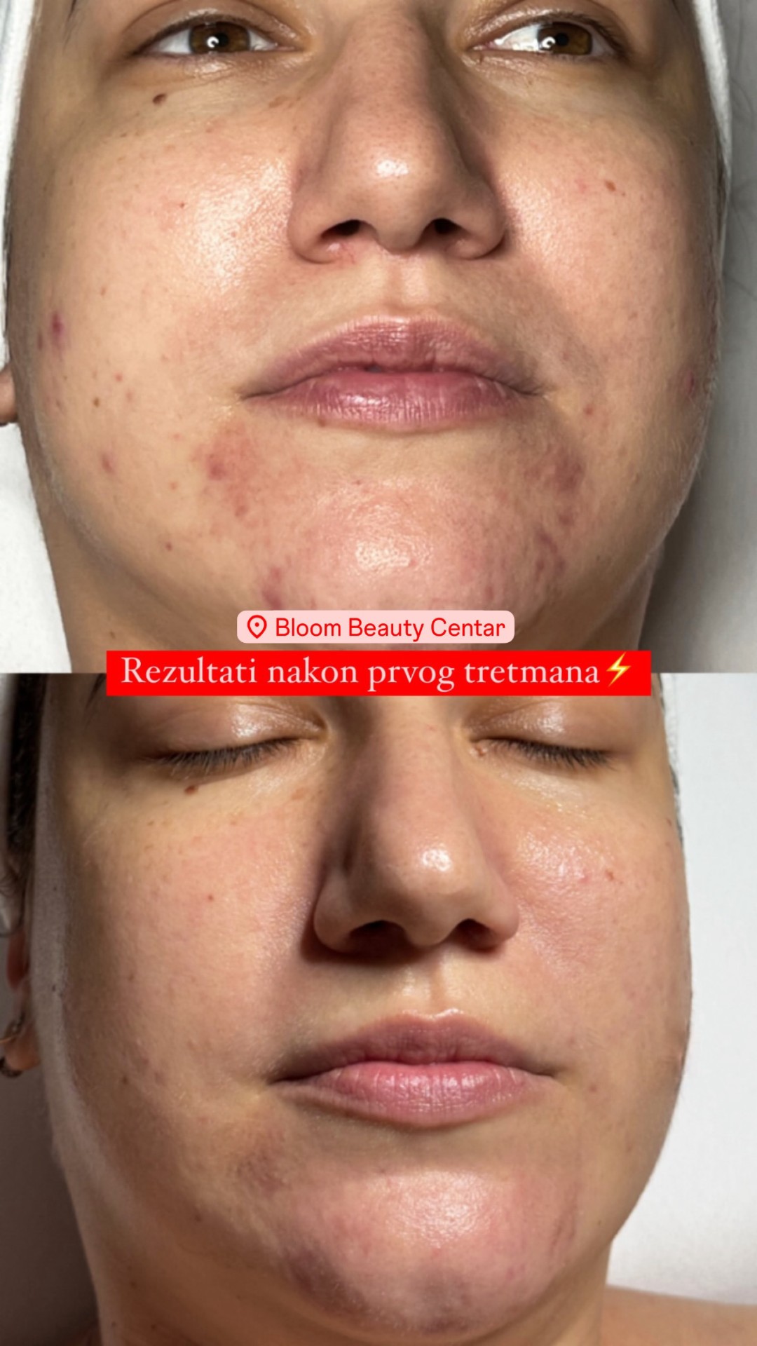 Bloom Beauty Centar #podgorica Tretman lica Skinderma tretman - azelaic peel