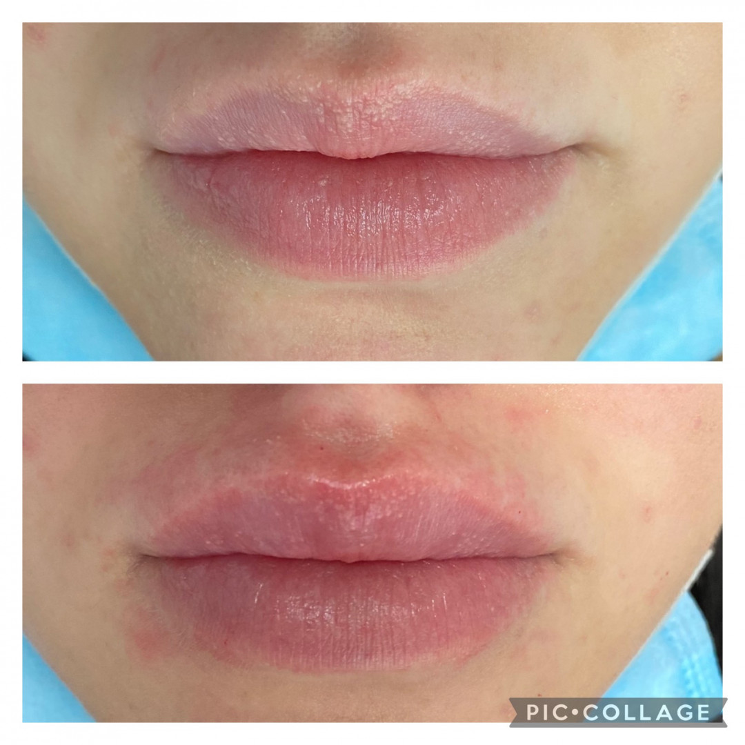 Hijaluronski fileri - 1 ml - Ordinacija Zečević, Podgorica Hijaluronski tretmani lica Lice Hijaluronski tretmani lica, Podgorica, Centar