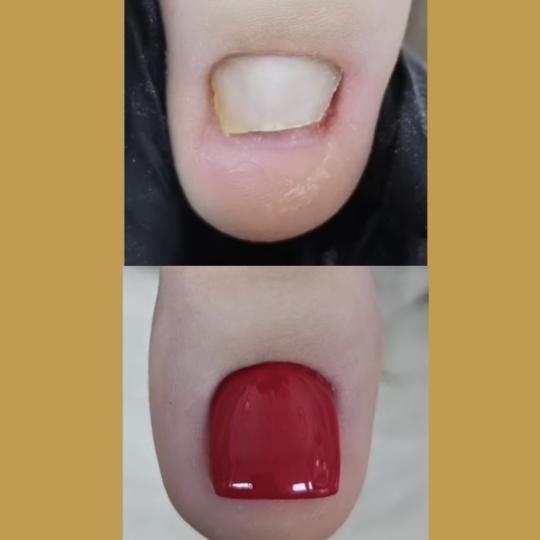 Sneža #podgorica Medicinski pedikir Čišćenje gljivičnog nokta+rekonstrukcija(FUNGI gelom-palac)