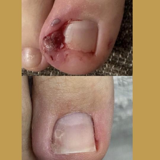 Sneža #podgorica Medicinski pedikir Urasli nokat 1 kom