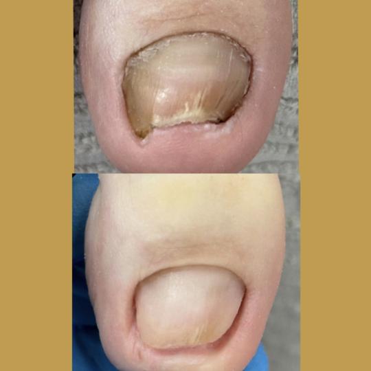Sneža #podgorica Medicinski pedikir Čišćenje 1 gljivičnog nokta - samostalno (bez nadogradnje)