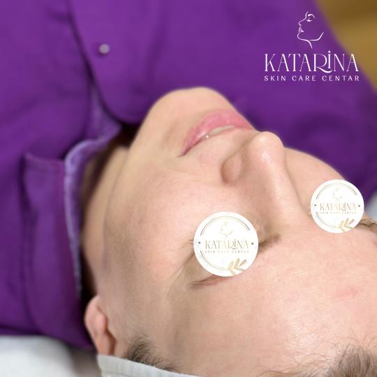 Katarina skin care centar #podgorica Tretman lica Mezoglow - hemijski piling + dermapen + mezoterapi