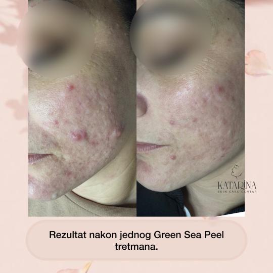 Katarina skin care centar #podgorica Tretman lica Green Sea peel Krx